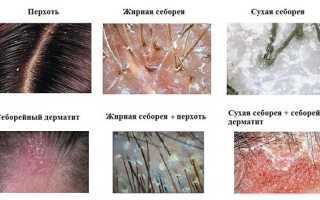 Лечение себореи в домашних условиях