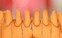 Восковое моделирование зубов как вариант планирования результата лечения