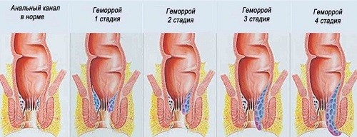 4 стадии развития геморроя